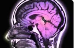 What Protein Causes Creutzfeldt Jakob Disease