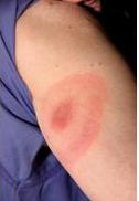 Image of the bull's eye Rash at tick bite site.